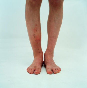brokenleg
